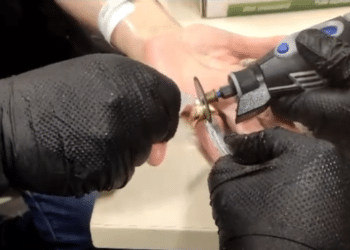 Los bomberos liberan el dedo de una mujer que no se podía sacar un anillo